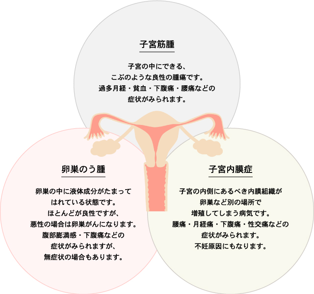 婦人科一般の説明図